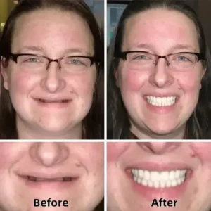SmileFitPro™-Advanced Custom-Fit Functional Dentures