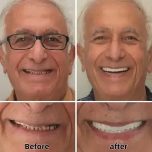 SmileFitPro™-Advanced Custom-Fit Functional Dentures