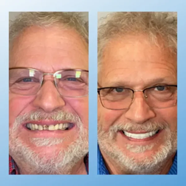 😁 "Snap In. Stay Put. Smile All Day — Or Your Money Back!" 𝗠𝗲𝗱𝗶𝗰𝗮𝗹-𝗚𝗿𝗮𝗱𝗲 𝗙𝘂𝗻𝗰𝘁𝗶𝗼𝗻𝗮𝗹 𝗧𝗵𝗶𝗰𝗸𝗲𝗻𝗲𝗱 𝗗𝗲𝗻𝘁𝘂𝗿𝗲𝘀
