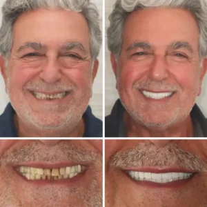 【Official Brand Store】Custom-Fit Functional Dentures — ProBite Stability Series