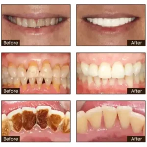 SmileFitPro™ Niacinamide Whitening Toothpaste