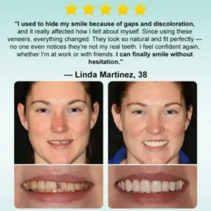🦷𝗢𝘂𝗿𝗹𝘆𝗮𝗿𝗱® 𝗜𝗻𝘀𝘁𝗮𝗻𝘁 𝗦𝘁𝗶𝗰𝗸-𝗼𝗻 𝗗𝗲𝗻𝘁𝗮𝗹 𝗩𝗲𝗻𝗲𝗲𝗿𝘀 (✅Clinically proven, easy-to-use dental veneers trusted by over 8,000 US users for a comfortable, natural smile.)