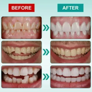 🦷𝗢𝘂𝗿𝗹𝘆𝗮𝗿𝗱® 𝗜𝗻𝘀𝘁𝗮𝗻𝘁 𝗦𝘁𝗶𝗰𝗸-𝗼𝗻 𝗗𝗲𝗻𝘁𝗮𝗹 𝗩𝗲𝗻𝗲𝗲𝗿𝘀 (✅Clinically proven, easy-to-use dental veneers trusted by over 8,000 US users for a comfortable, natural smile.)