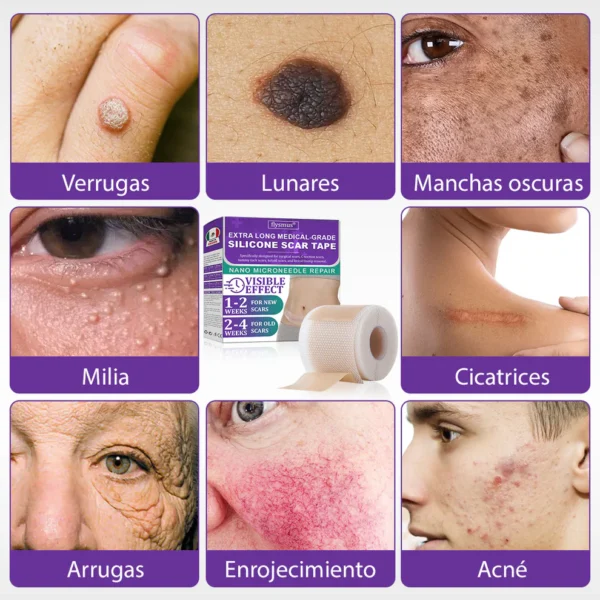 🏷️ Tienda Oficial: Flysmus® ReGen Cinta de Micronadles con Ácido Hialurónico Nano-Heal 💝 Tratamiento de cicatrices nuevas y antiguas, reducción de cicatrices quirúrgicas, estrías, queloides, acné, quemaduras, verrugas, dermatomas y venas varicosas