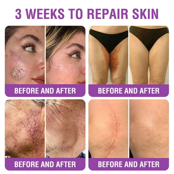 YUNPSO™ Queen Nectar Peptide + Bakuchiol Skin Restoration Cream - Anti-aging, Hydrating, Skin Firming & Lifting, Skin Repair, Even Tone, Acne and Dark Spot Treatment, Wart and Mole Removal, and Psoriasis Relief.