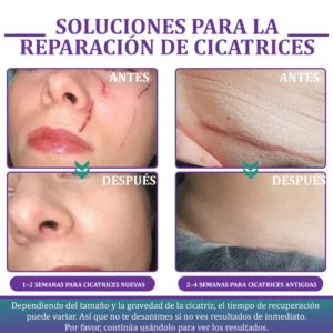 🏷️ Tienda Oficial: Flysmus® ReGen Cinta de Micronadles con Ácido Hialurónico Nano-Heal 💝 Tratamiento de cicatrices nuevas y antiguas, reducción de cicatrices quirúrgicas, estrías, queloides, acné, quemaduras, verrugas, dermatomas y venas varicosas
