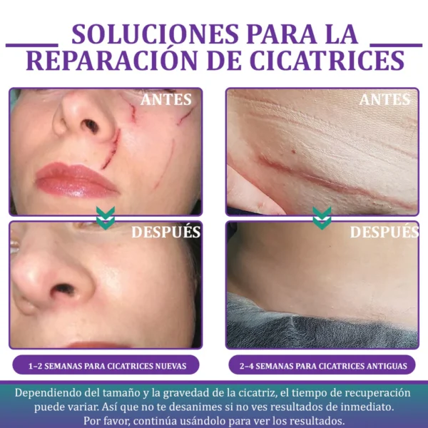 🏷️ Tienda Oficial: Flysmus® ReGen Cinta de Micronadles con Ácido Hialurónico Nano-Heal 💝 Tratamiento de cicatrices nuevas y antiguas, reducción de cicatrices quirúrgicas, estrías, queloides, acné, quemaduras, verrugas, dermatomas y venas varicosas