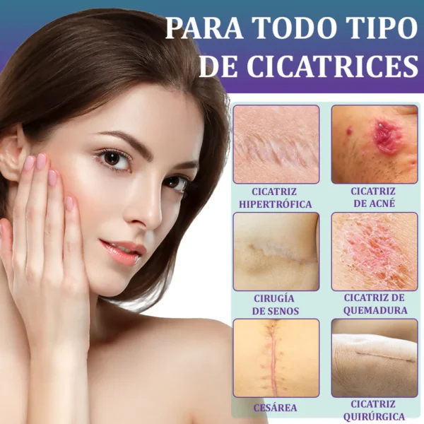 🏷️ Tienda Oficial: Flysmus® ReGen Cinta de Micronadles con Ácido Hialurónico Nano-Heal 💝 Tratamiento de cicatrices nuevas y antiguas, reducción de cicatrices quirúrgicas, estrías, queloides, acné, quemaduras, verrugas, dermatomas y venas varicosas