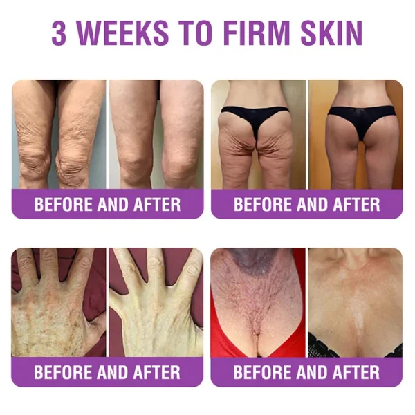 YUNPSO™ Queen Nectar Peptide + Bakuchiol Skin Restoration Cream - Anti-aging, Hydrating, Skin Firming & Lifting, Skin Repair, Even Tone, Acne and Dark Spot Treatment, Wart and Mole Removal, and Psoriasis Relief.