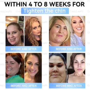 🇨🇦Clinically Proven| Official Store | BuildLeaf® Tirzepatide Slimming & Health Nano Microneedle Patch |Targets Obesity, Loose Skin, High Blood Pressure, Diabetes, Fatty Liver, Joint Pain, Brain Fog, Low Energy, Body Aches, and More