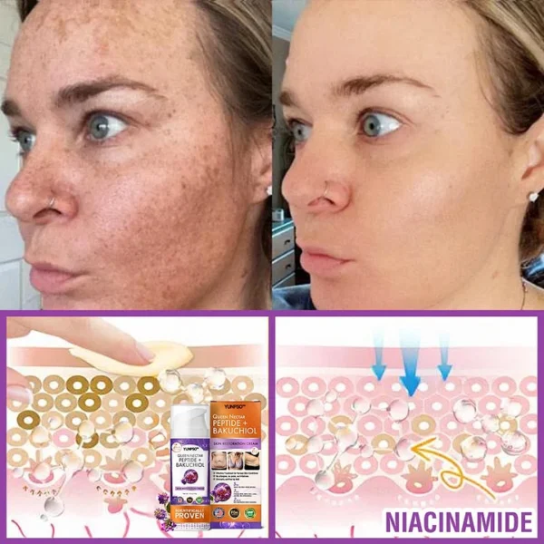 YUNPSO™ Queen Nectar Peptide + Bakuchiol Skin Restoration Cream - Anti-aging, Hydrating, Skin Firming & Lifting, Skin Repair, Even Tone, Acne and Dark Spot Treatment, Wart and Mole Removal, and Psoriasis Relief.