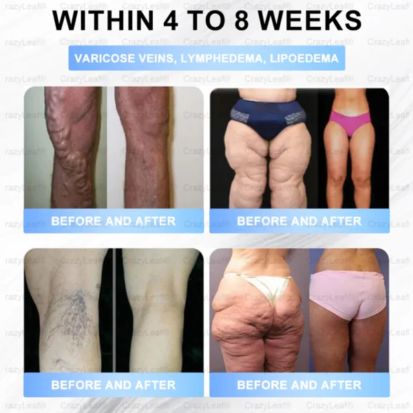 🇨🇦Clinically Proven| Official Store | BuildLeaf® Tirzepatide Slimming & Health Nano Microneedle Patch |Targets Obesity, Loose Skin, High Blood Pressure, Diabetes, Fatty Liver, Joint Pain, Brain Fog, Low Energy, Body Aches, and More