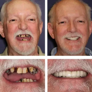 LAOZIK™-Advanced Custom-Fit Functional Dentures