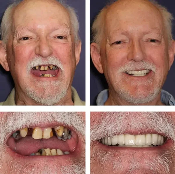 LAOZIK™-Advanced Custom-Fit Functional Dentures