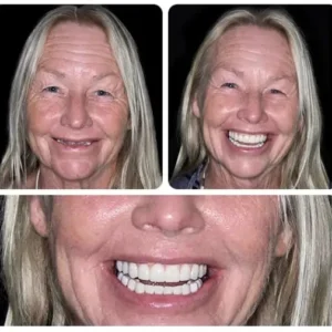 LAOZIK™-Advanced Custom-Fit Functional Dentures