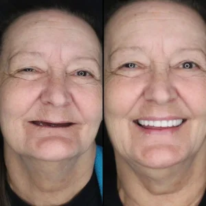 LAOZIK™-Advanced Custom-Fit Functional Dentures