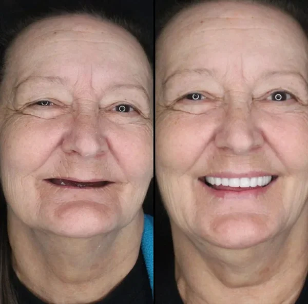 LAOZIK™-Advanced Custom-Fit Functional Dentures