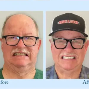 NESLEMY™ Custom-Fit Functional Dentures – Perfectly Fitted in Minutes at Home