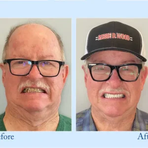 NESLEMY™ Custom-Fit Functional Dentures