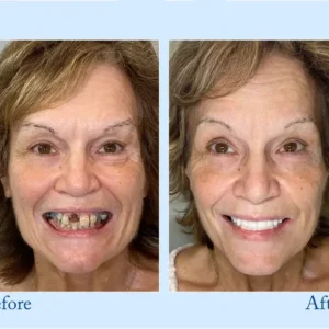 NESLEMY™ Custom-Fit Functional Dentures