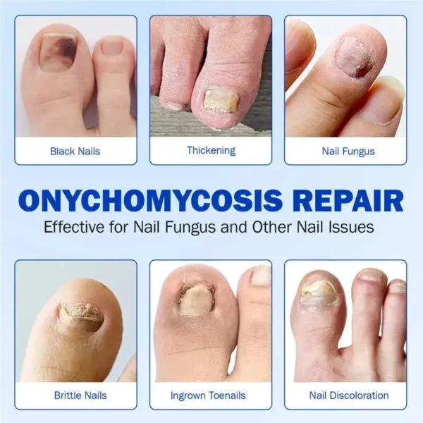 NESLEMY™ Nail Fungus Care Patches