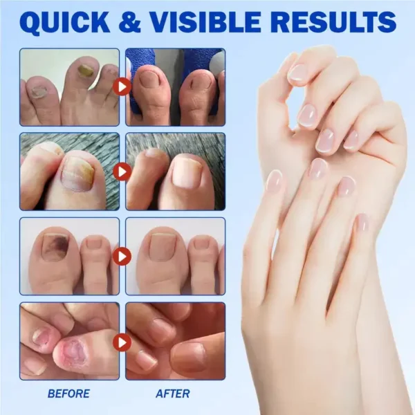 NESLEMY™ Nail Fungus Care Patches