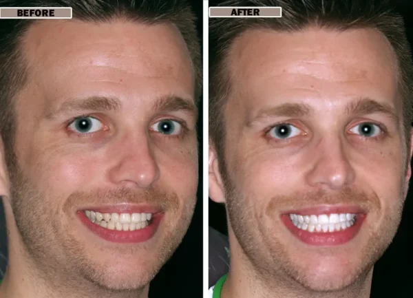 NESLEMY™Coconut Whitening Strips