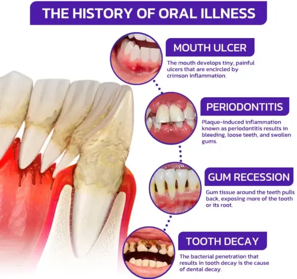 🇬🇧👨🏼⚕️Rolimey® VioGloss Bee Venom Dental Therapy Oral Power🦷