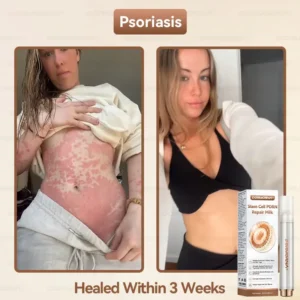 𝐷𝑂𝑅𝑀𝑂𝑅𝑁𝐴® 🍀 𝐒𝐭𝐞𝐦 𝐂𝐞𝐥𝐥 𝐏𝐃𝐑𝐍 𝐑𝐞𝐩𝐚𝐢𝐫 𝐌𝐢𝐥𝐤 🍁 | 𝟐𝟎𝟎𝟎𝐏𝐏𝐌 𝐄𝐱𝐨𝐬𝐨𝐦𝐞-𝐈𝐧𝐟𝐮𝐬𝐞𝐝 𝐟𝐨𝐫 𝐒𝐤𝐢𝐧 𝐑𝐞𝐠𝐞𝐧𝐞𝐫𝐚𝐭𝐢𝐨𝐧 & 𝐈𝐦𝐩𝐞𝐫𝐟𝐞𝐜𝐭𝐢𝐨𝐧 𝐂𝐨𝐫𝐫𝐞𝐜𝐭𝐢𝐨𝐧