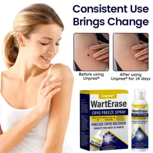 Unpree® WartErase Cryo Freeze Spray