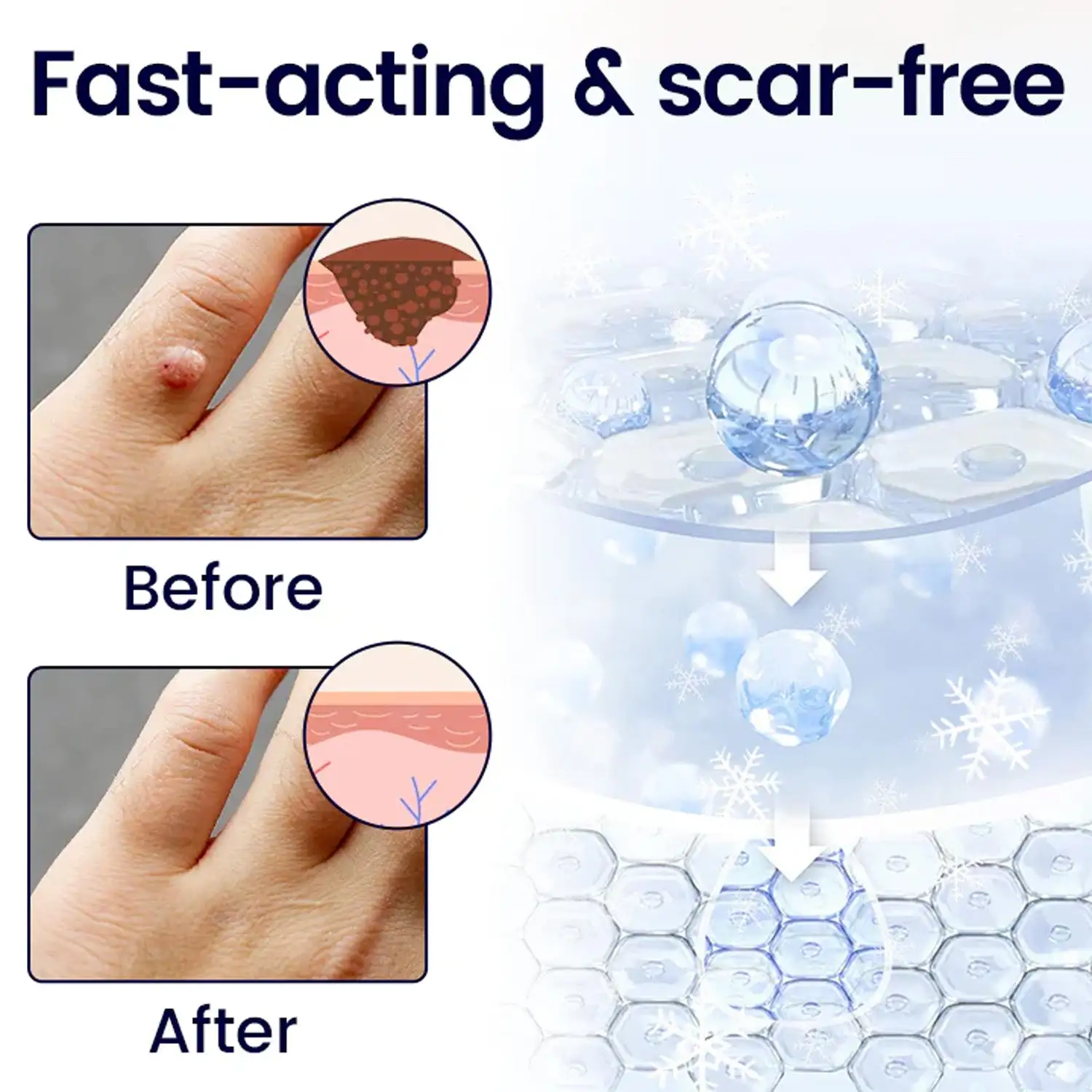 Unpree® WartErase Cryo Freeze Spray