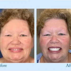 Hidone™ – Premium-Zahnprothese