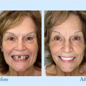 Hidone™ – Premium-Zahnprothese