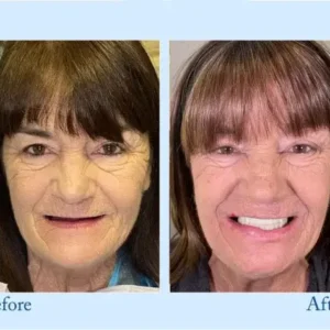 Hidone™ – Premium-Zahnprothese