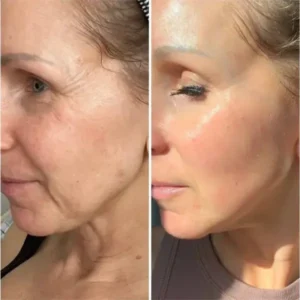 Hidone™ The Vita A Retinal Shot Tightening Booster